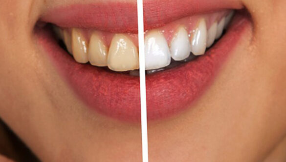 ขูดหินปูน ควรทำเมื่อไหร่!