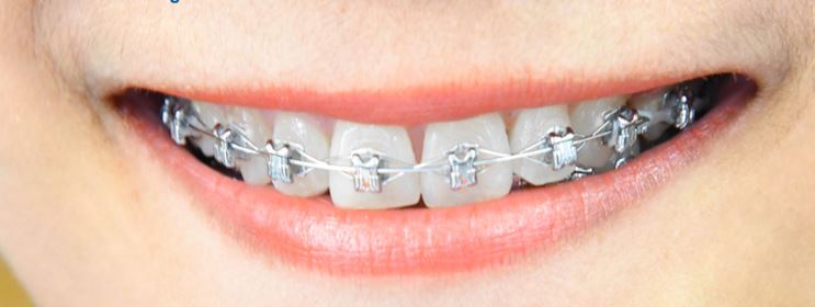 การจัดฟันแบบดามอน