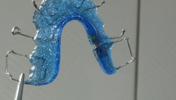 ทำความสะอาดรีเทนเนอร์ ด้วยวิธีง่ายๆ