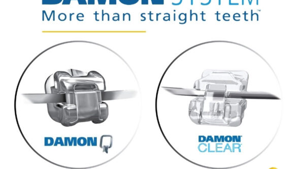 ไม่ต้องถอนฟัน ก็จัดฟันแบบดามอนได้