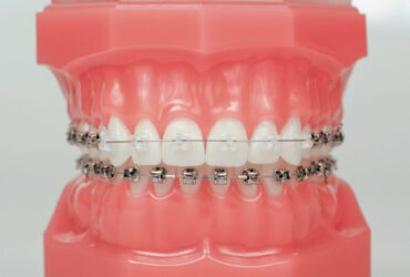 Damon_Clear_Q_Typodont-830x800