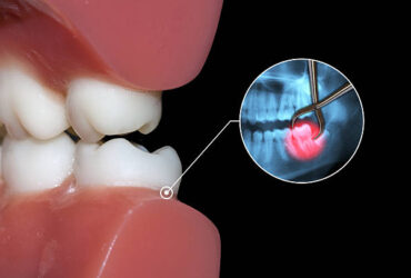 dental infographic surgery operation extraction tooth