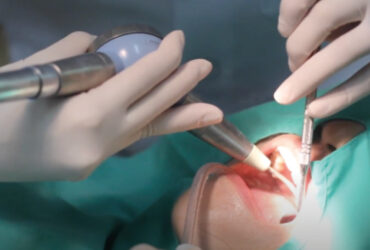 Air Flow ขจัดคราบฟัน