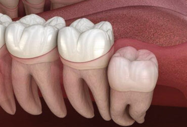 ผ่าฟันคุด