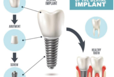 รากฟันเทียม