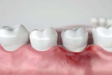 โรคเหงือก เหงือกร่น ปริทันต์ เหงือกอักเสบ