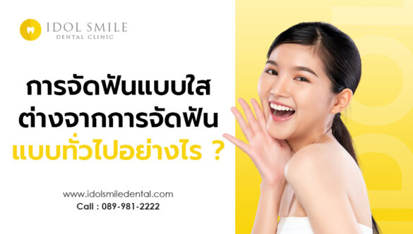 การจัดฟันแบบใส ต่างจากการจัดฟันแบบทั่วไป อย่างไรบ้าง