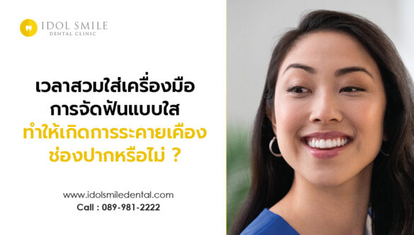 เวลาสวมใส่เครื่องมือการจัดฟันแบบใส จะทำให้เกิดการระคายเคืองช่องปากหรือไม่