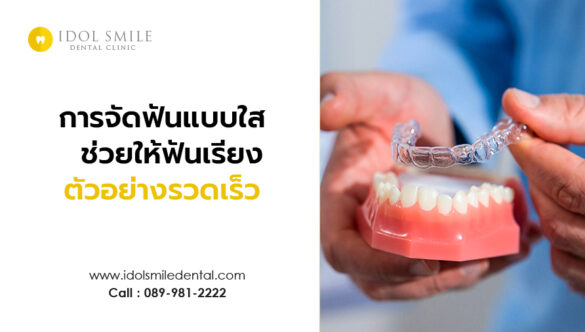 การจัดฟันแบบใส ช่วยให้ฟันเรียงตัวอย่างรวดเร็ว