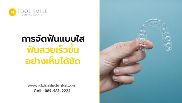 การจัดฟันแบบใส  ฟันสวยเร็วขึ้นอย่างเห็นได้ชัด