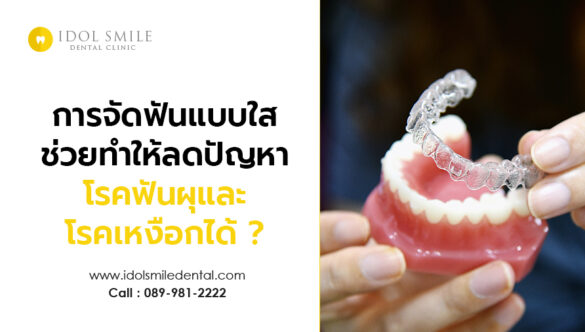 การจัดฟันแบบใส ช่วยทำให้ลดปัญหาโรคฟันผุและโรคเหงือกได้