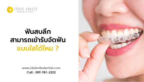 ฟันสบลึก สามารถเข้ารับจัดฟันเเบบใสได้ไหม