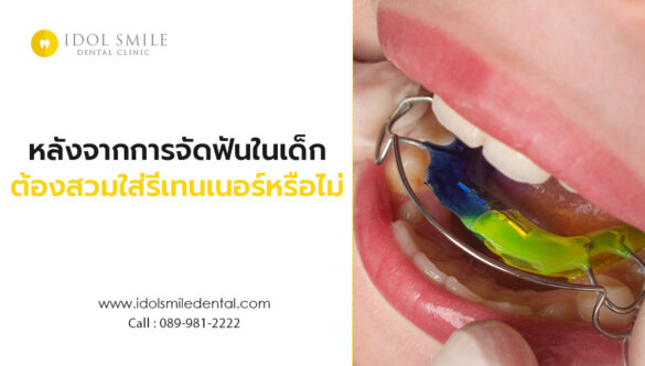 หลังจากการจัดฟันในเด็ก ต้องสวมใส่รีเทนเนอร์หรือไม่