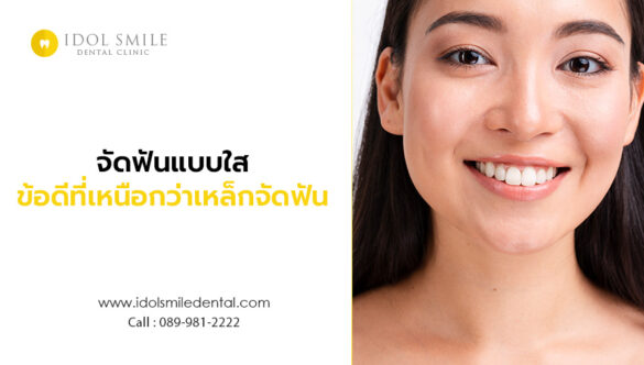 จัดฟันแบบใส ข้อดี ที่เหนือกว่าเหล็กจัดฟัน